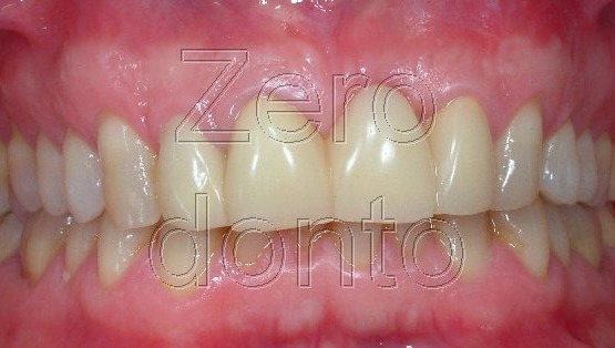 1-ortodonzia invisibile affollamento denti