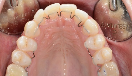 Invisible bracketless orthodontics, nowadays the most thin available appliance.