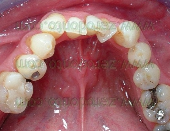 2-denti sovrapposti affolamento