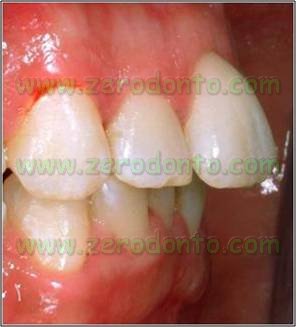 2-denti sporgenti affollamento dentario