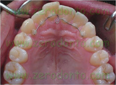 3-ortodonzia invisibile senza stelline