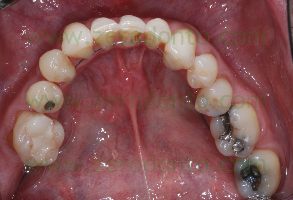 4-ortodonzia invisibile linguale