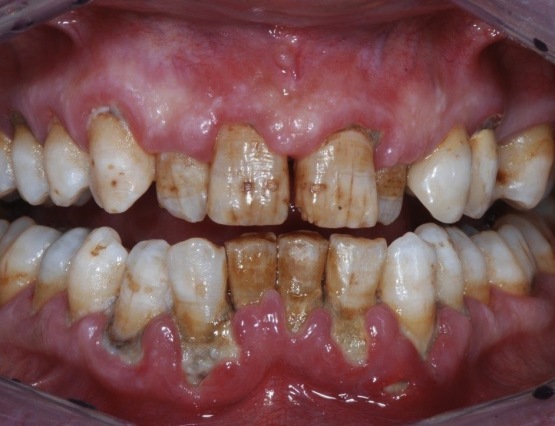 6-tartaro parodontologia napoli 1