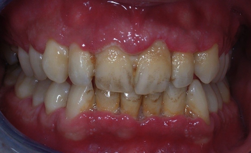 7-tartaro parodontite