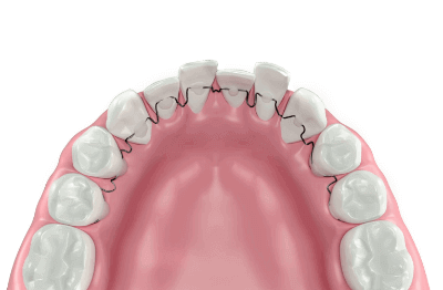 Invisible-Bracketless-Fixed-Lingual-Orthodontics