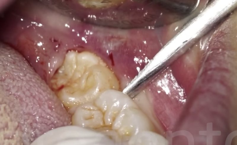 How To Get Food Out Of Wisdom Teeth Holes Without Syringe