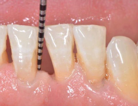 tooth mobility