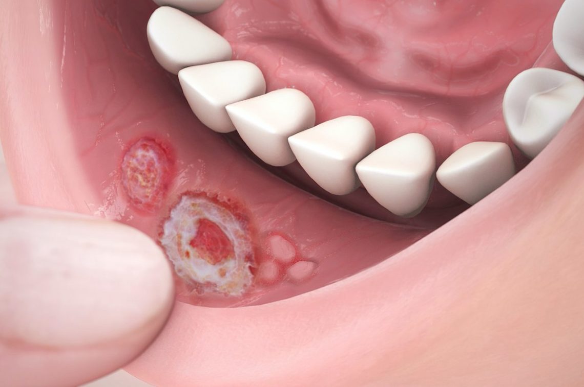 aphthous ulcers