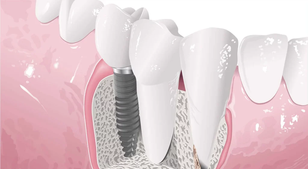 implantology naples